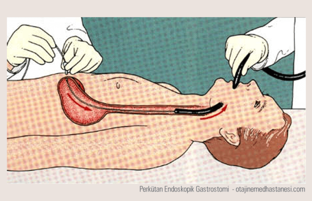 PEG Nedir?