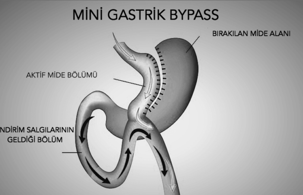 Mini Gastrik Bypass