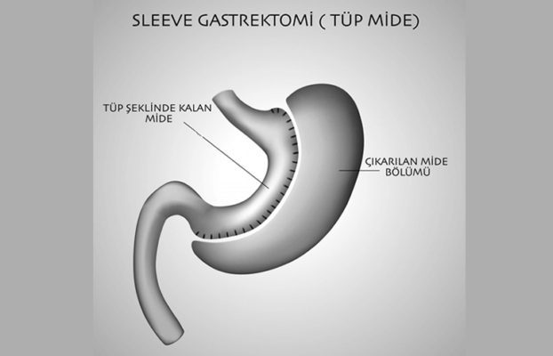 Tüp Mide Ameliyatı (Sleeve Gastrektomi)